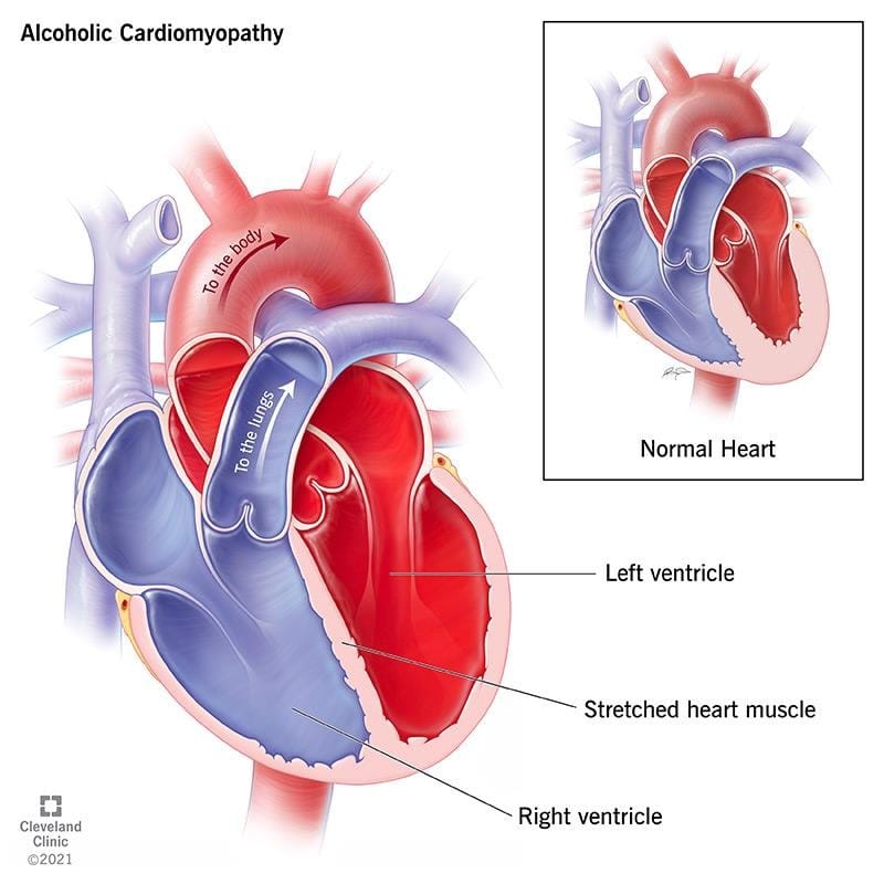 Alcohol-Induced Cardiomyopathy: Causes, Symptoms and Treatment