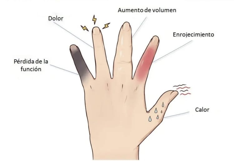 #6. La inflamación: la verdadera clave de la enfermedad cardiovascular.